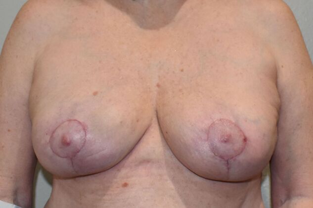 Breast Implant Removal: Case 23 - After
