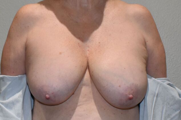 Breast Implant Removal: Case 23 - Before