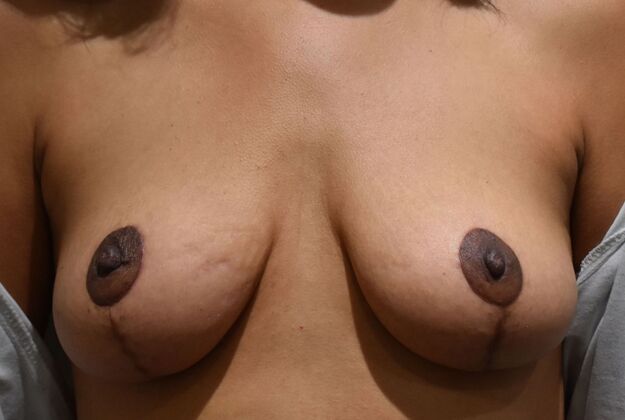 Breast Lift (Mastopexy) Case 157 - After