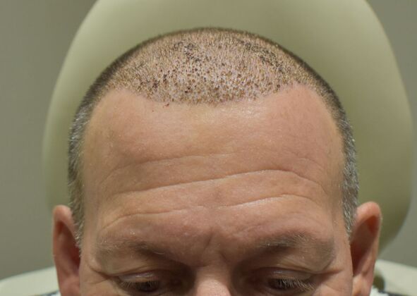 Hair Transplantation Case 3 - After