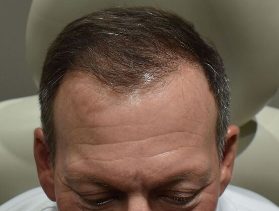 Hair Transplantation Case 3 - Before