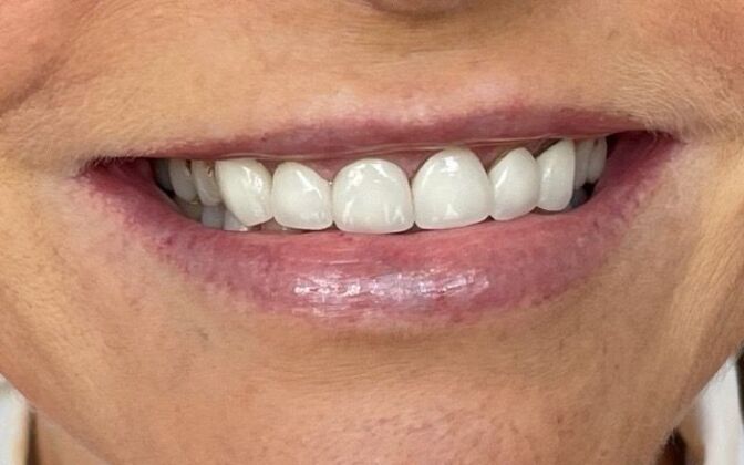 Smile Makeovers Case 25 - Before