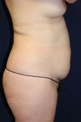 Liposuction & Safe Lipo: Case 55 - Before