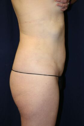 Liposuction & Safe Lipo: Case 55 - After