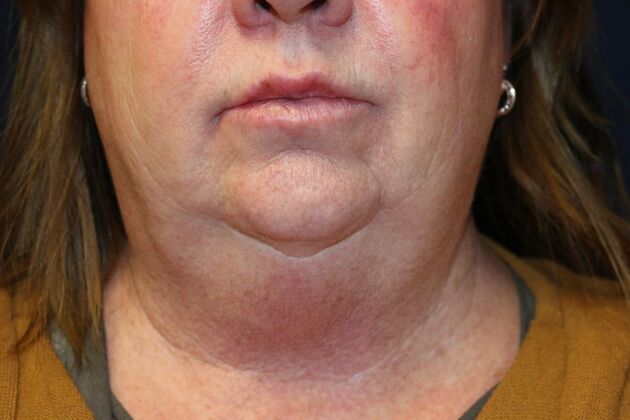 Neck Sculpting : Case 14 - Before