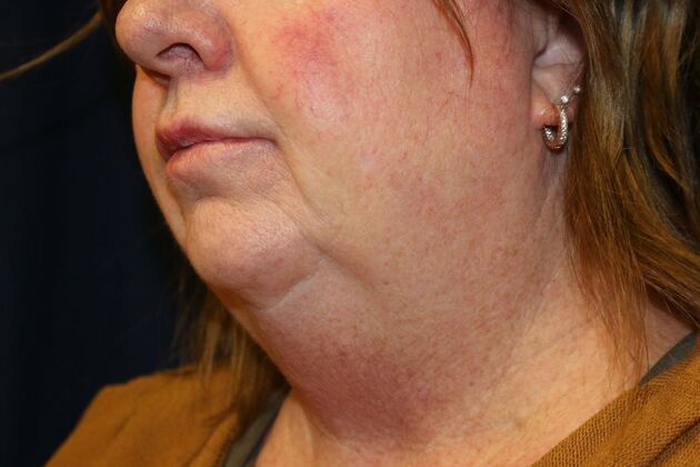 Neck Sculpting : Case 14 - Before