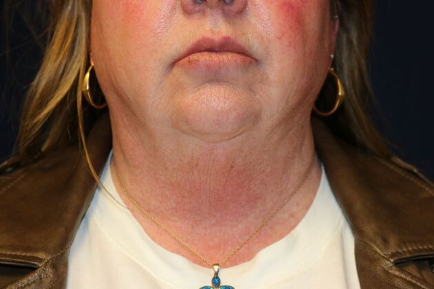 Neck Sculpting : Case 14 - After