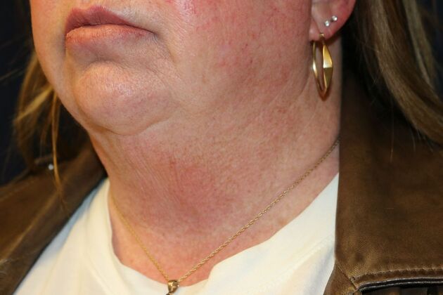 Neck Sculpting : Case 14 - After