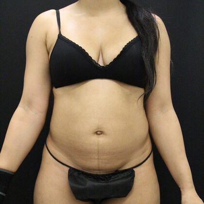 Brazilian Butt Lift: Case 9 - Before