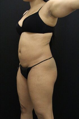 Brazilian Butt Lift: Case 9 - Before