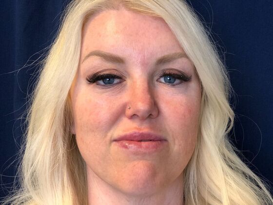 Cosmetic Tattooing: Brows and Eyeliner - After