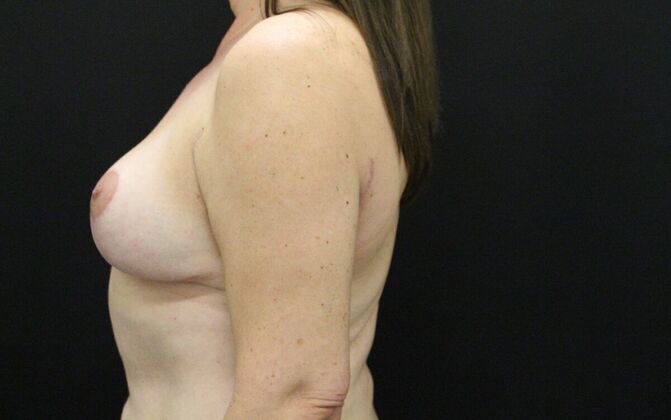 Breast Lift/Breast Lift Augmentation: Case 33 - After