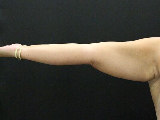 Arm Lift Case 18 - Before