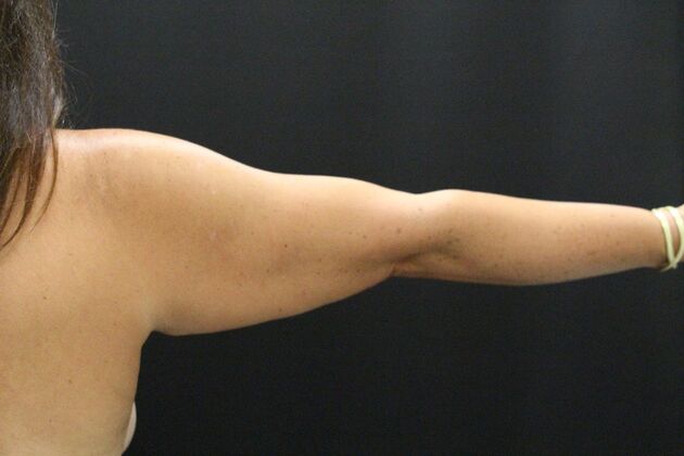 Arm Lift: Case 18 - Before