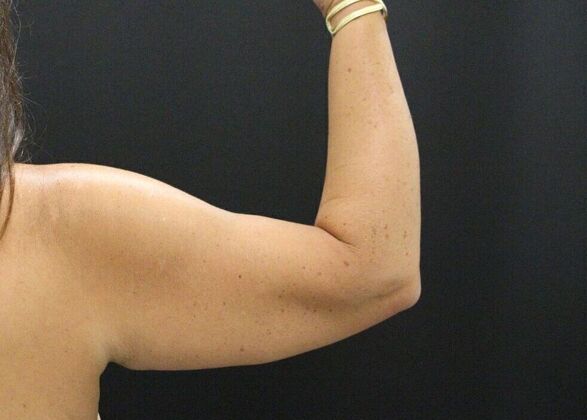 Arm Lift: Case 18 - Before