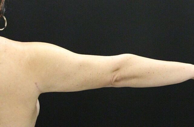 Arm Lift: Case 18 - After