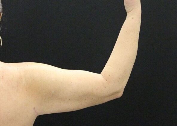 Arm Lift: Case 18 - After