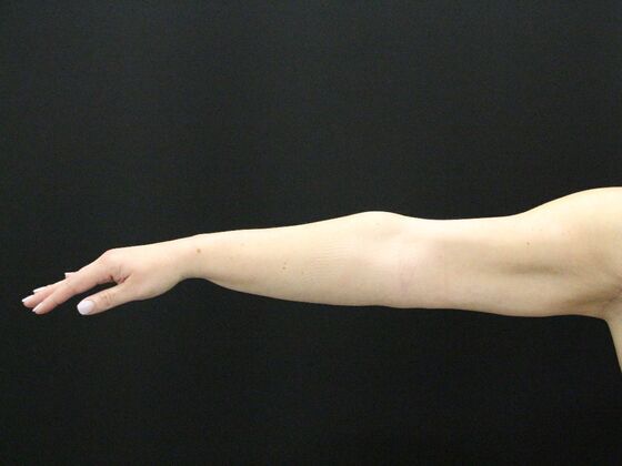 Arm Lift Case 18 - After