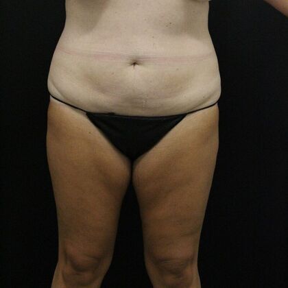 Liposuction Case 25 - Before