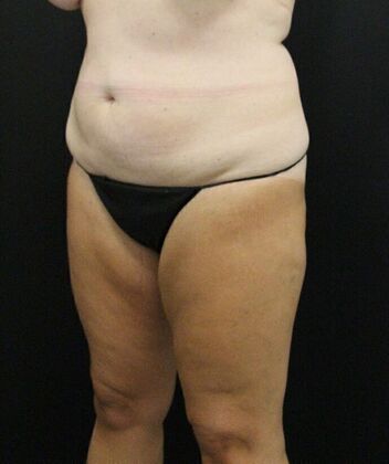 Liposuction: Case 25 - Before