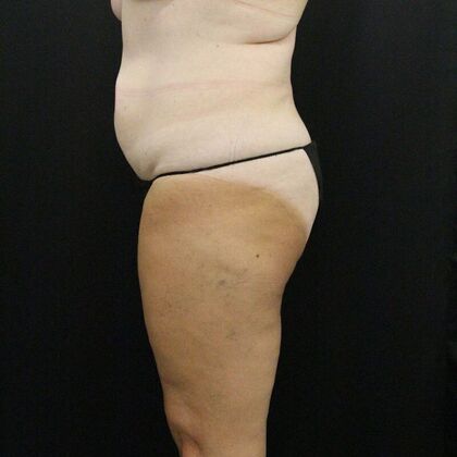 Liposuction: Case 25 - Before