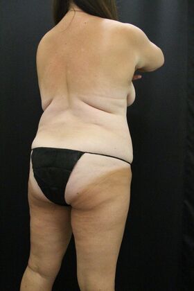 Liposuction: Case 25 - Before