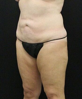 Liposuction: Case 25 - After