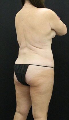 Liposuction: Case 25 - After
