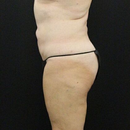 Liposuction: Case 25 - After