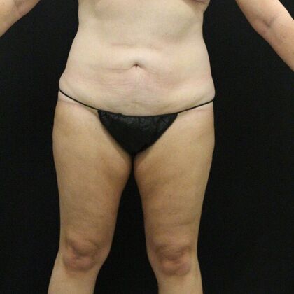 Liposuction Case 25 - After