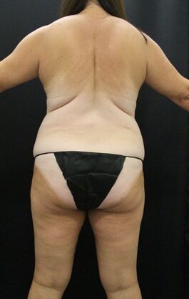 Liposuction: Case 25 - Before