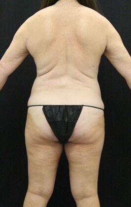 Liposuction: Case 25 - After