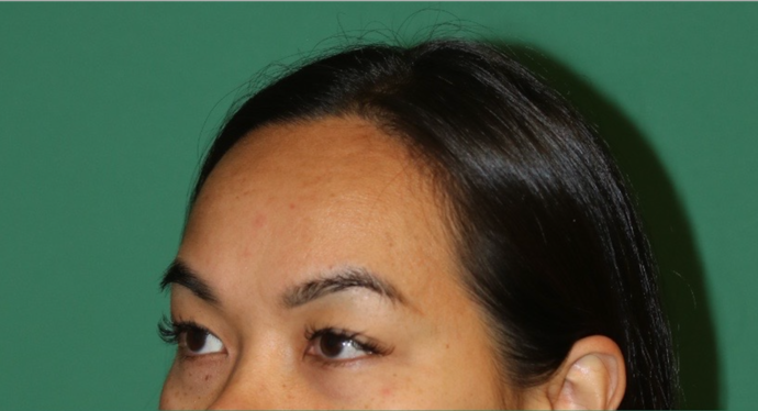 Hairline Lowering Surgery Case 19 - Before