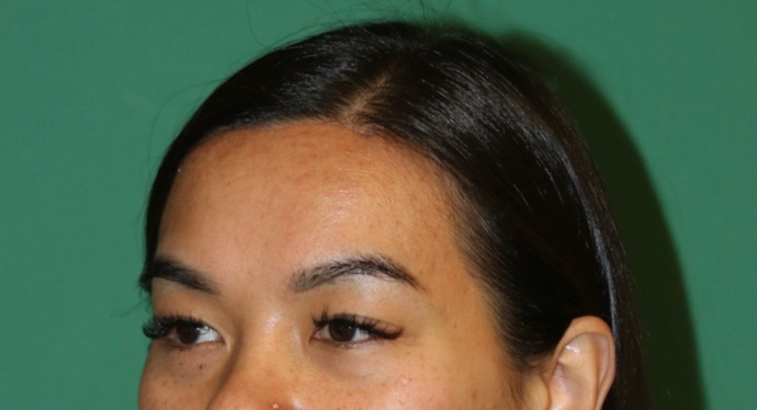 Hairline Lowering Surgery Case 19 - After