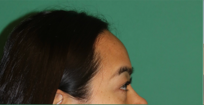 Hairline Lowering Surgery: Case 19 - Before