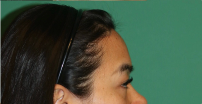 Hairline Lowering Surgery: Case 19 - After