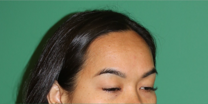 Hairline Lowering Surgery: Case 19 - Before
