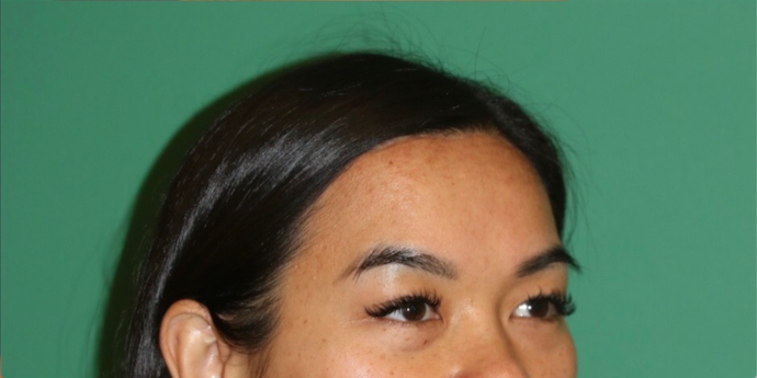 Hairline Lowering Surgery: Case 19 - After