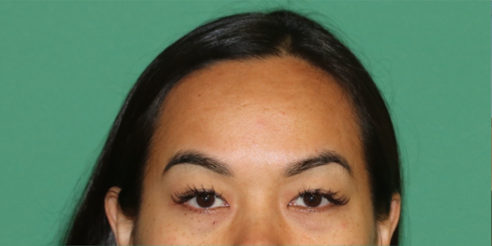 Hairline Lowering Surgery: Case 19 - Before