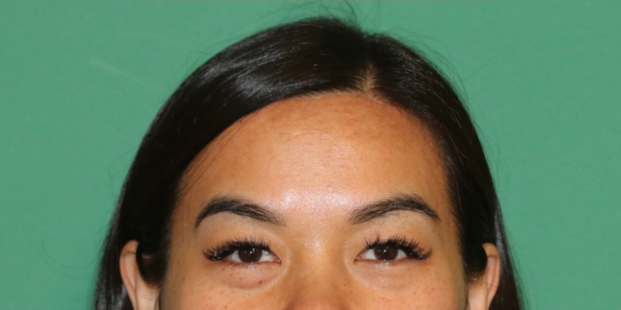 Hairline Lowering Surgery: Case 19 - After