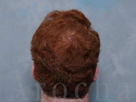 FUT Hair Restoration Case 1 - Before
