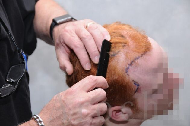 FUT Hair Restoration: Case 1 - Before