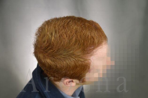 FUT Hair Restoration: Case 1 - After