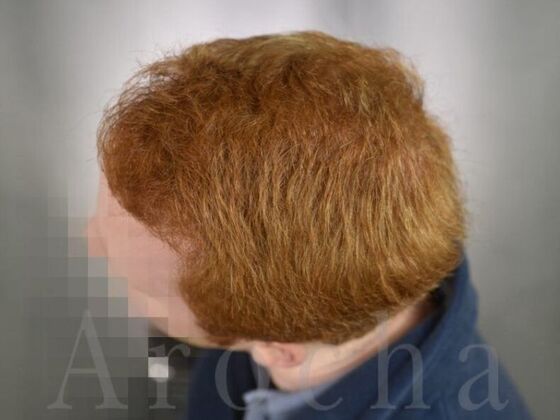 FUT Hair Restoration: Case 1 - After