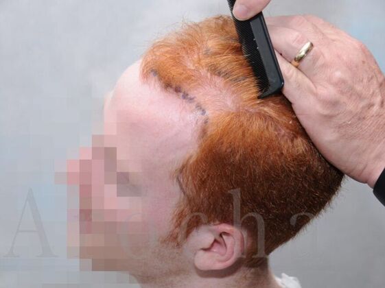 FUT Hair Restoration: Case 1 - Before