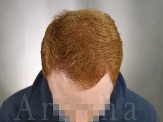 FUT Hair Restoration: Case 1 - After