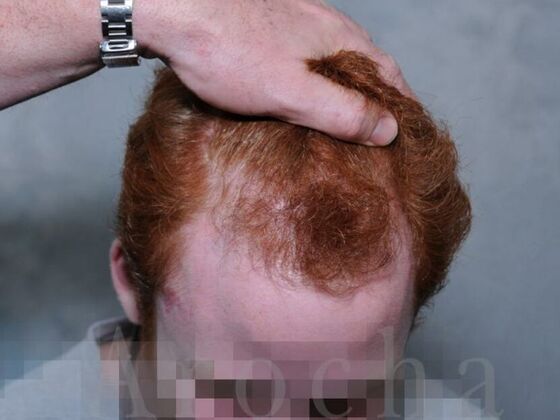 FUT Hair Restoration: Case 1 - Before