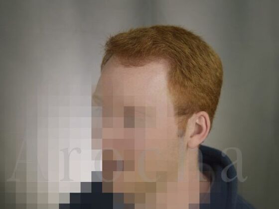 FUT Hair Restoration: Case 1 - After