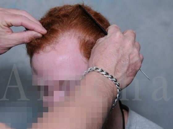 FUT Hair Restoration: Case 1 - Before