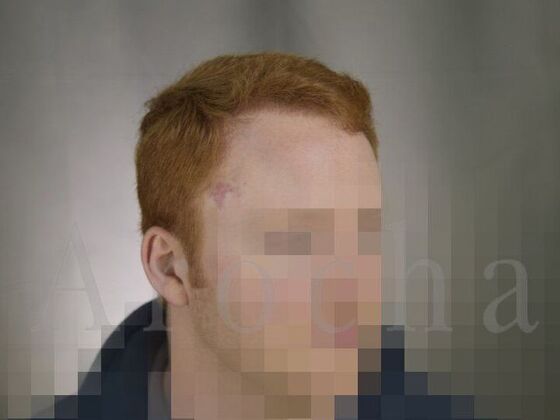 FUT Hair Restoration: Case 1 - After